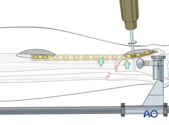 胫骨简单横形骨折的MIPO加压钢板内固定AO指南