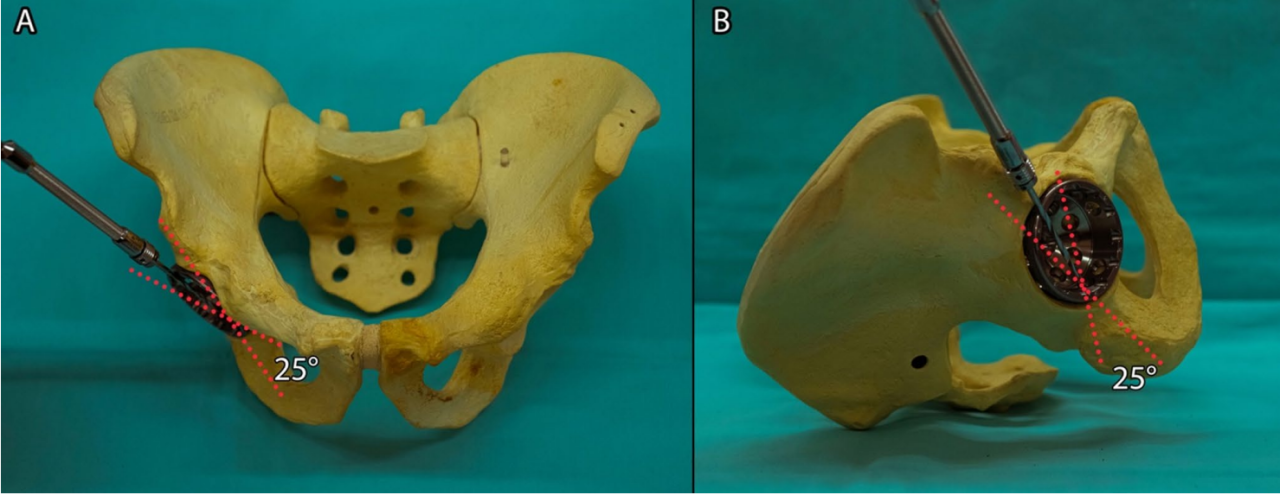 初次和翻修全髋关节置换术中髋臼螺钉的置入，掌握要点看这篇！