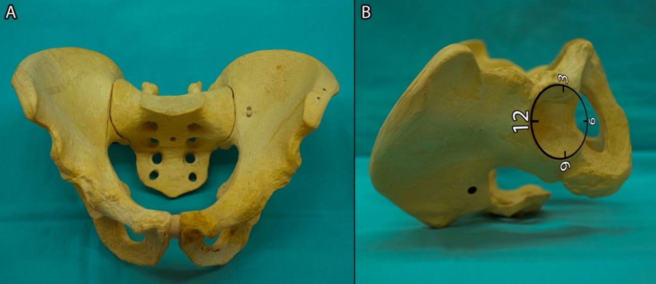 初次和翻修全髋关节置换术中髋臼螺钉的置入，掌握要点看这篇！