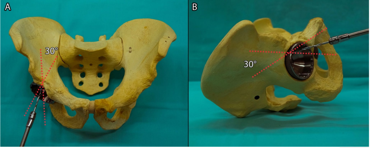 初次和翻修全髋关节置换术中髋臼螺钉的置入，掌握要点看这篇！