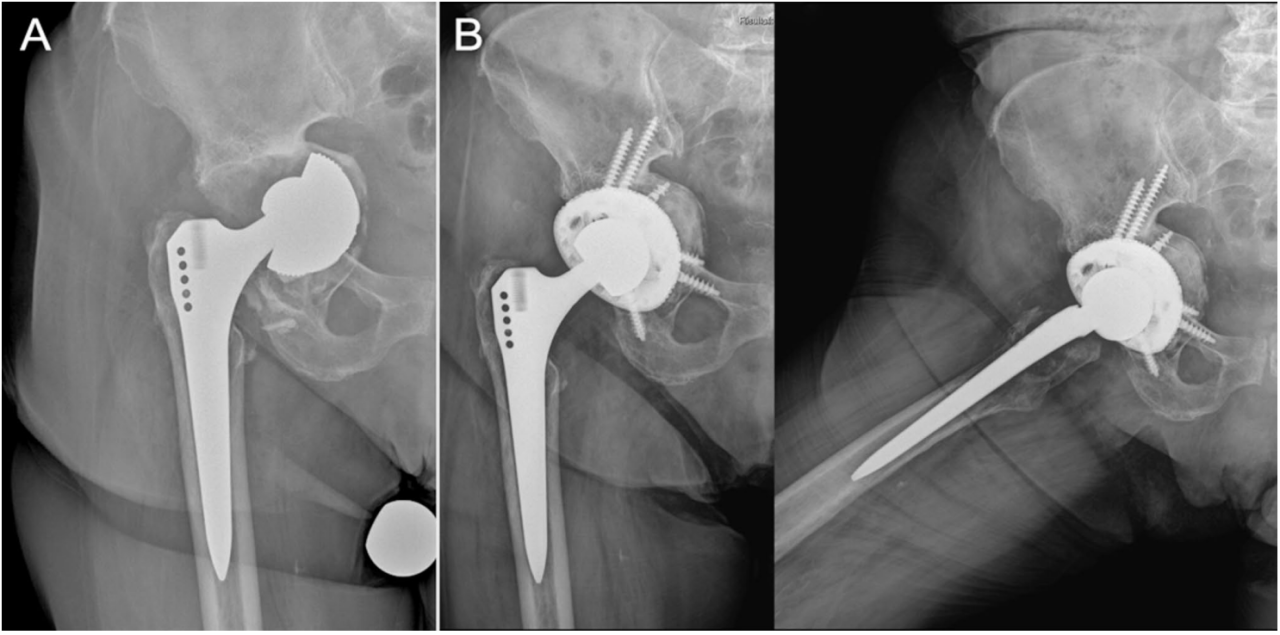 初次和翻修全髋关节置换术中髋臼螺钉的置入，掌握要点看这篇！