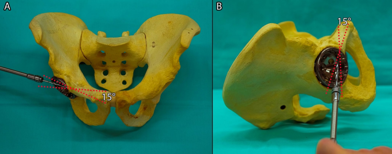 初次和翻修全髋关节置换术中髋臼螺钉的置入，掌握要点看这篇！