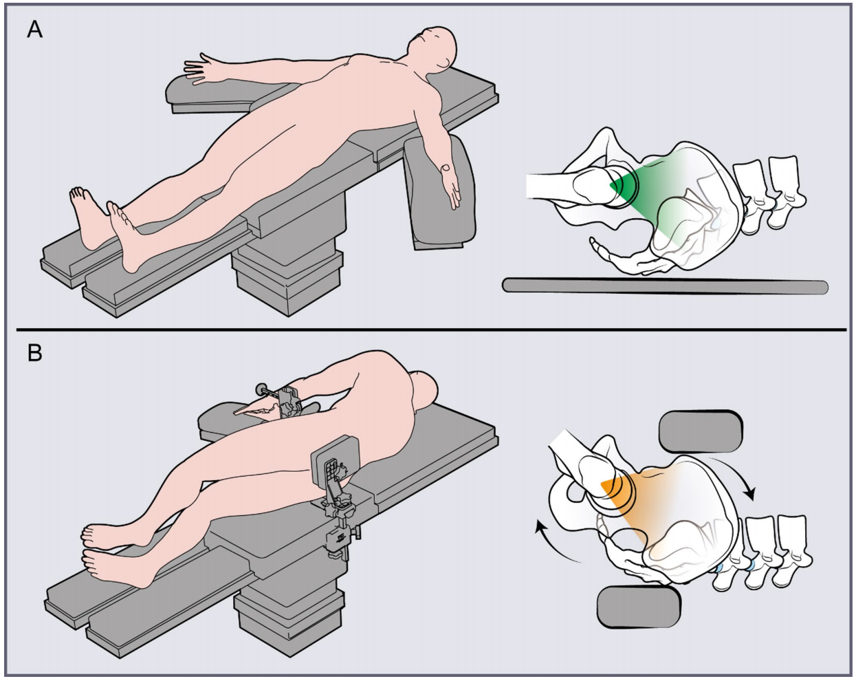初次和翻修全髋关节置换术中髋臼螺钉的置入，掌握要点看这篇！