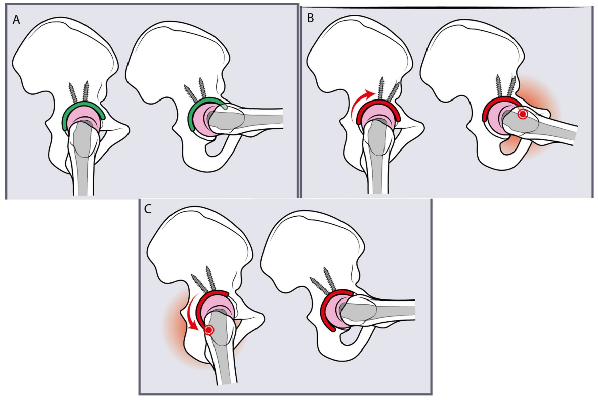 初次和翻修全髋关节置换术中髋臼螺钉的置入，掌握要点看这篇！