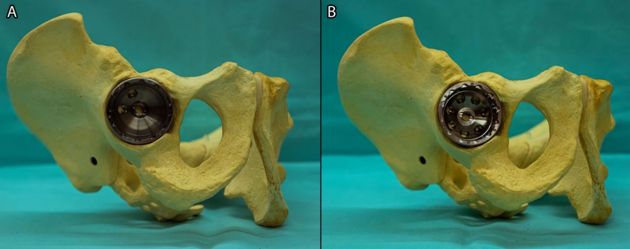 初次和翻修全髋关节置换术中髋臼螺钉的置入，掌握要点看这篇！
