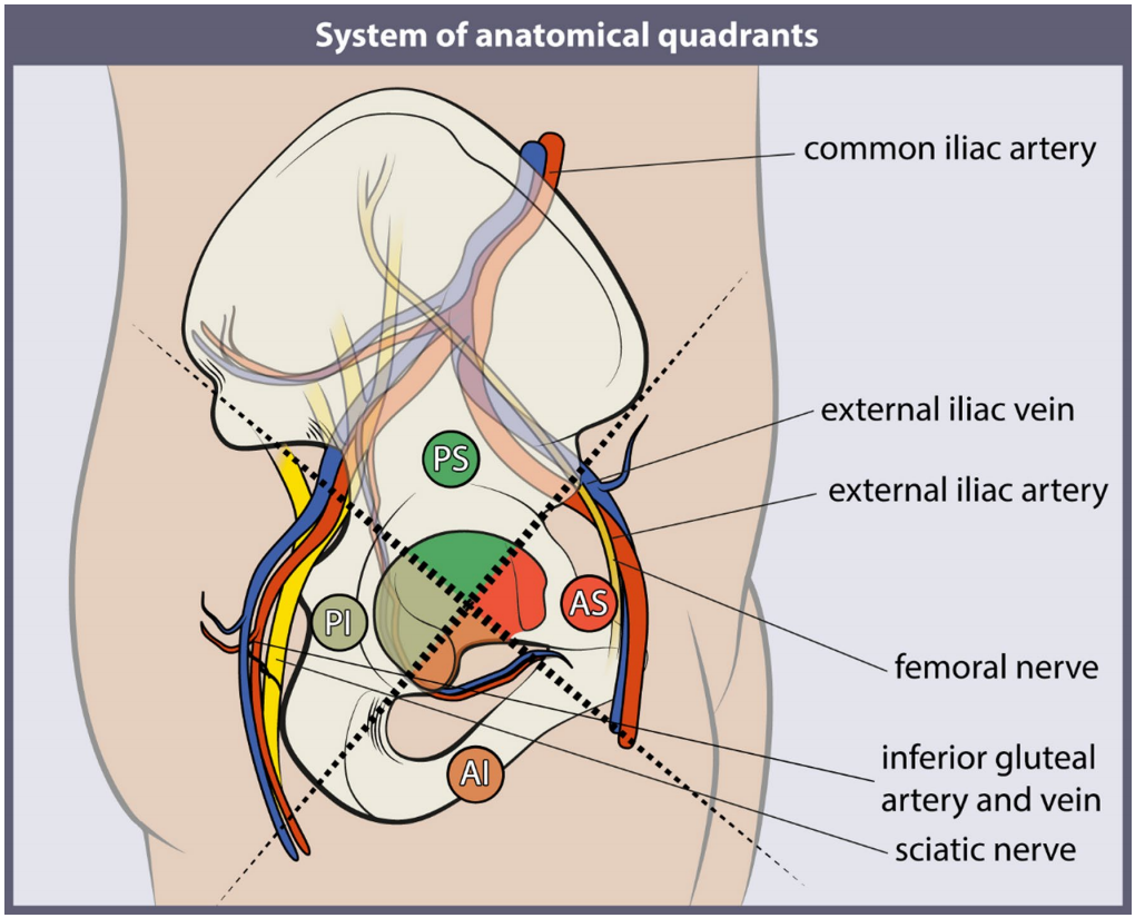 初次和翻修全髋关节置换术中髋臼螺钉的置入，掌握要点看这篇！