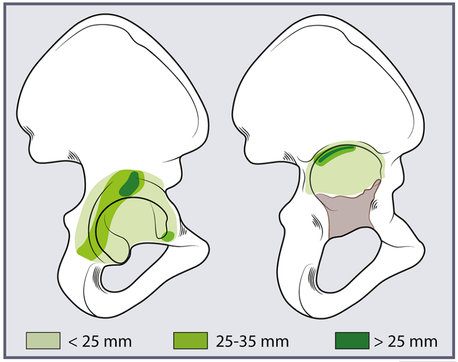 初次和翻修全髋关节置换术中髋臼螺钉的置入，掌握要点看这篇！
