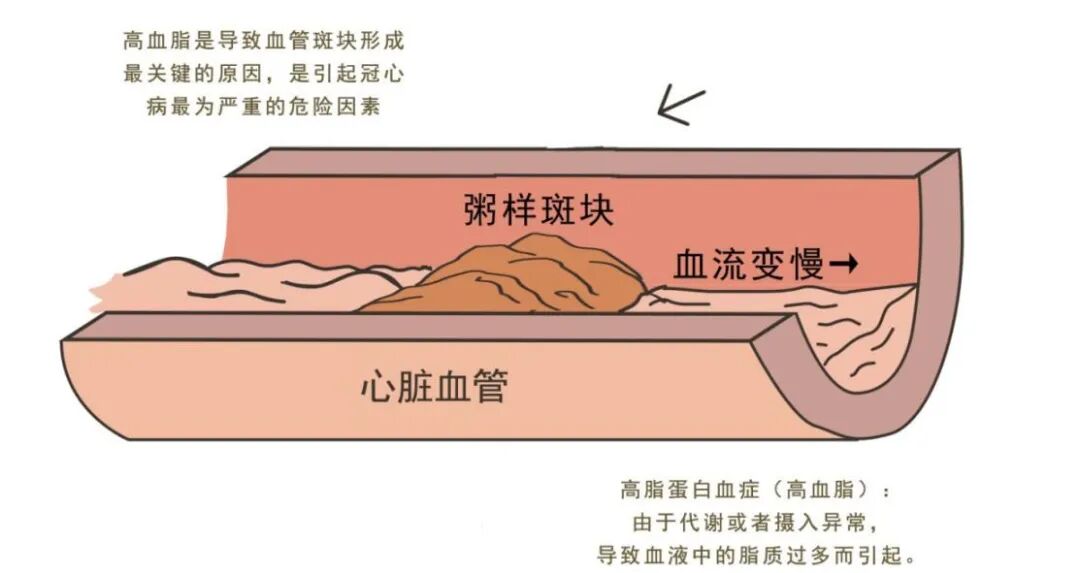 他汀类降脂药的服用注意事项