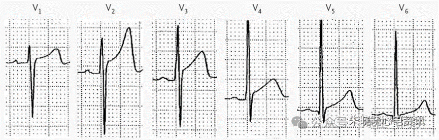 ST段抬高的识别及相关疾病的鉴别,这篇文章给你讲清楚了!