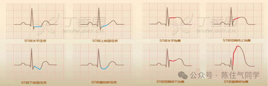ST段抬高的识别及相关疾病的鉴别,这篇文章给你讲清楚了!