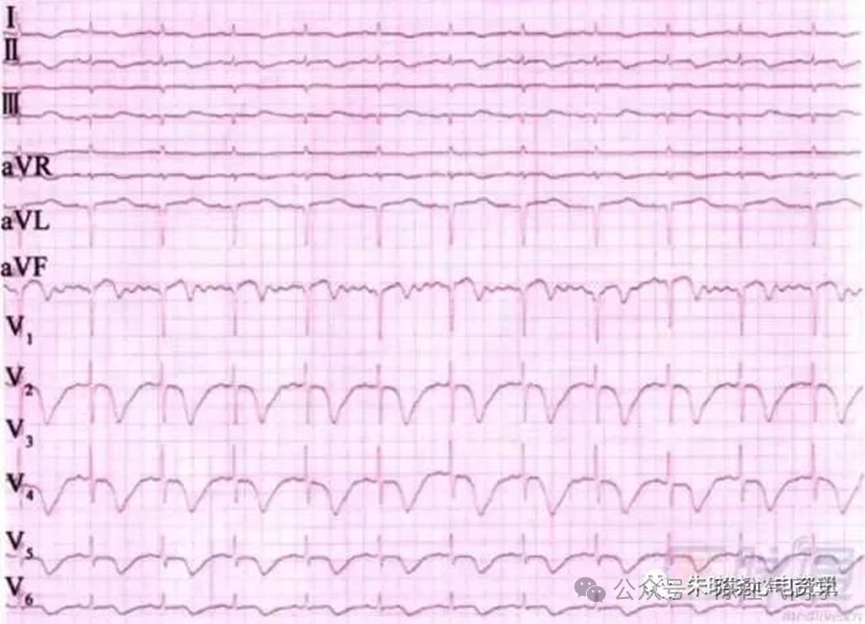 ST段抬高的识别及相关疾病的鉴别,这篇文章给你讲清楚了!