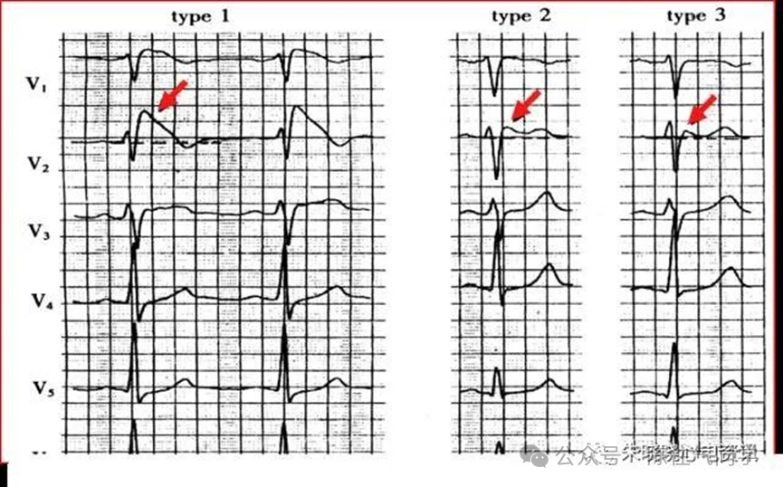 ST段抬高的识别及相关疾病的鉴别,这篇文章给你讲清楚了!