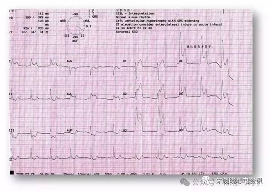 ST段抬高的识别及相关疾病的鉴别,这篇文章给你讲清楚了!