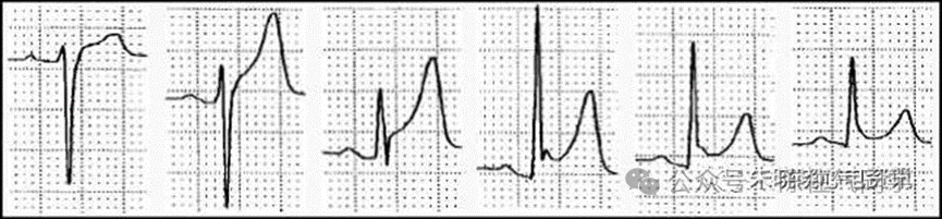 ST段抬高的识别及相关疾病的鉴别,这篇文章给你讲清楚了!