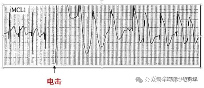 ST段抬高的识别及相关疾病的鉴别,这篇文章给你讲清楚了!