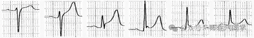 ST段抬高的识别及相关疾病的鉴别,这篇文章给你讲清楚了!