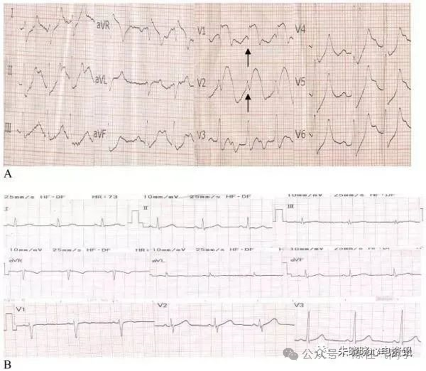 ST段抬高的识别及相关疾病的鉴别,这篇文章给你讲清楚了!
