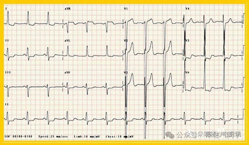 ST段抬高的识别及相关疾病的鉴别,这篇文章给你讲清楚了!
