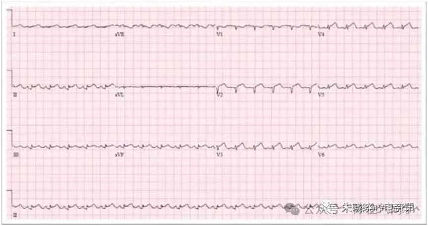 ST段抬高的识别及相关疾病的鉴别,这篇文章给你讲清楚了!