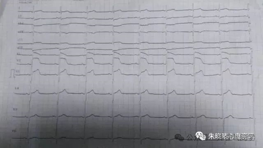 ST段抬高的识别及相关疾病的鉴别,这篇文章给你讲清楚了!