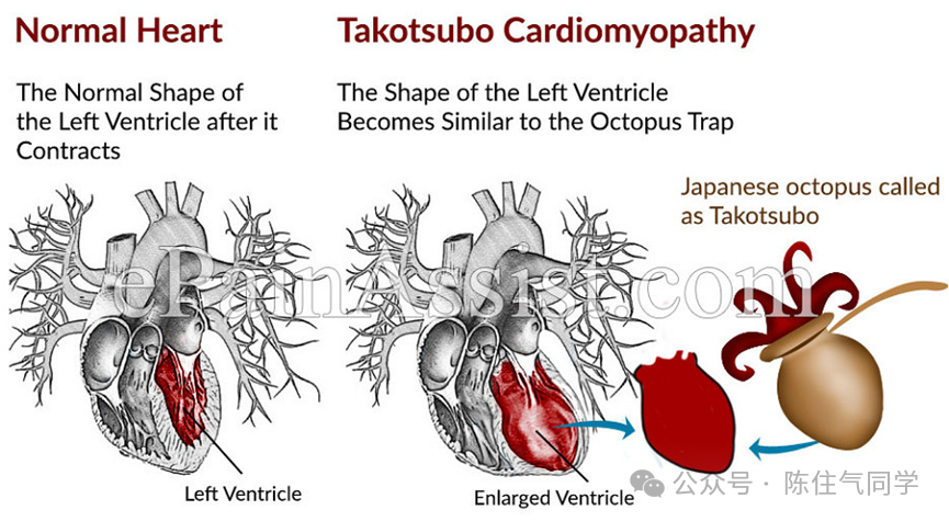 ST段抬高的识别及相关疾病的鉴别,这篇文章给你讲清楚了!