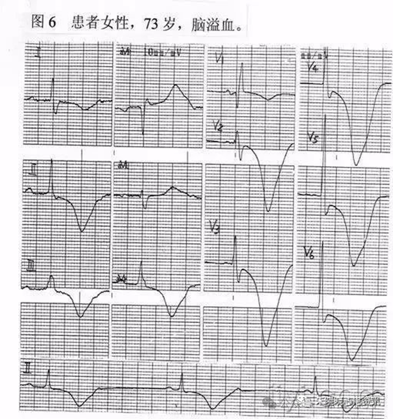 ST段抬高的识别及相关疾病的鉴别,这篇文章给你讲清楚了!