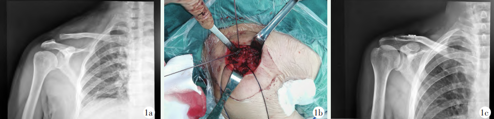 肩锁关节脱位治疗新选择:三种内固定方法,值得一看!