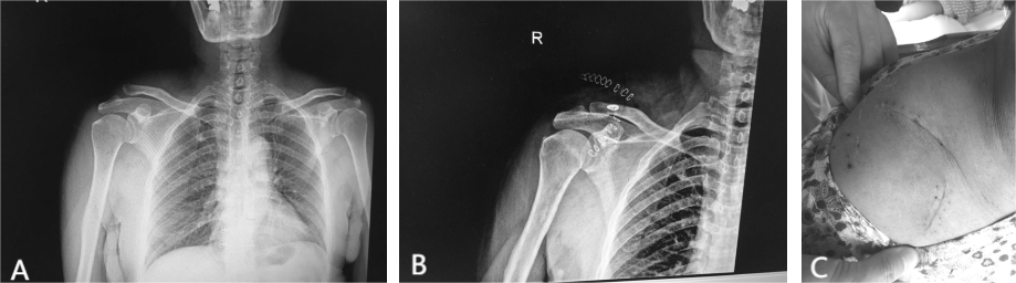 肩锁关节脱位治疗新选择:三种内固定方法,值得一看!