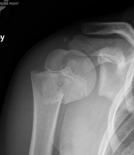 儿童肱骨近端骨折的治疗