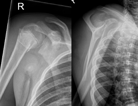 儿童肱骨近端骨折的治疗
