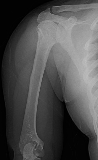 儿童肱骨近端骨折的治疗