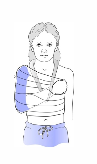 儿童肱骨近端骨折的治疗