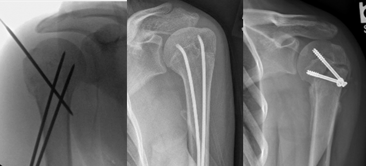 儿童肱骨近端骨折的治疗