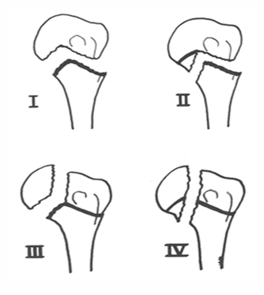 儿童肱骨近端骨折的治疗