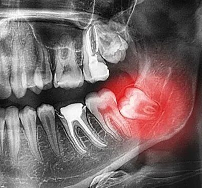 1例拔牙引起医疗事故鉴定引发的思考