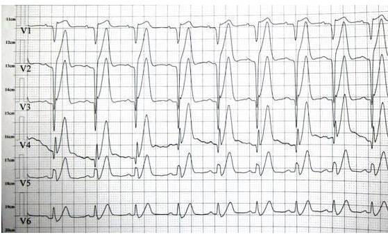 T波高尖，可能会是哪些疾病？