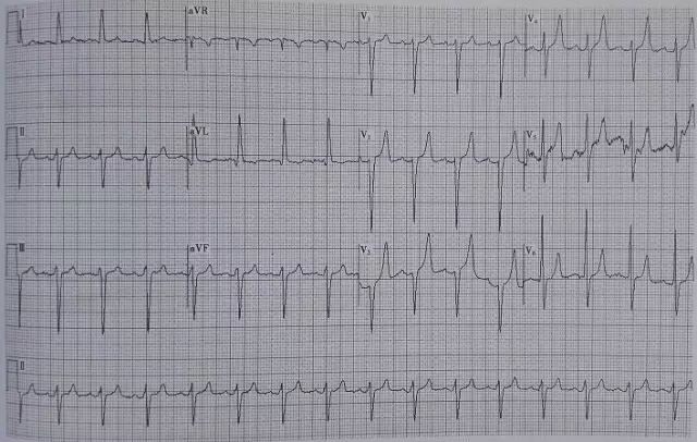 T波高尖，可能会是哪些疾病？