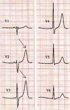 T波高尖，可能会是哪些疾病？