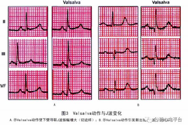 恶性早期复极综合征的心电图特点