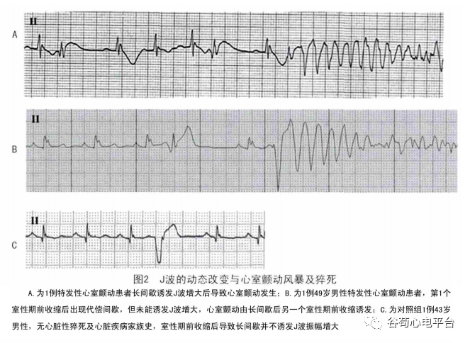 恶性早期复极综合征的心电图特点