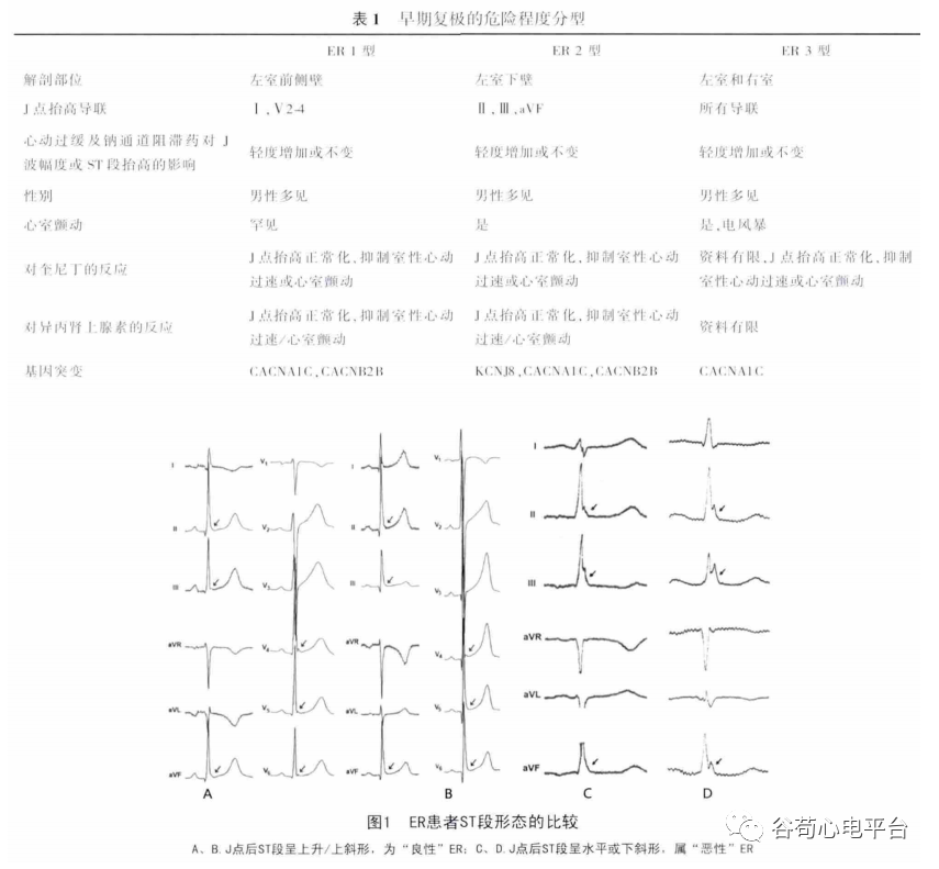 恶性早期复极综合征的心电图特点