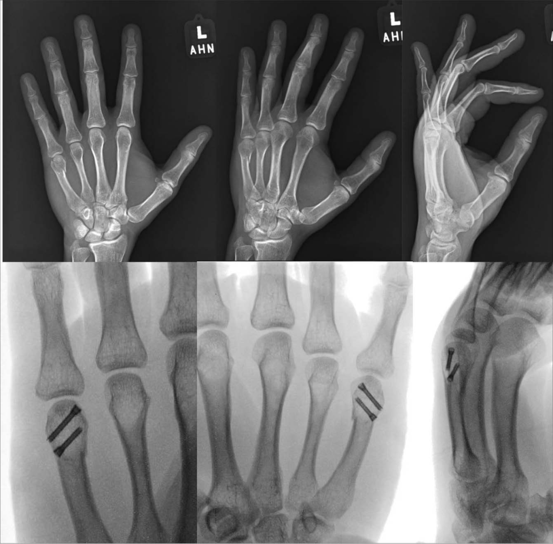 如何精准施策？掌骨骨折的治疗方案全景解读