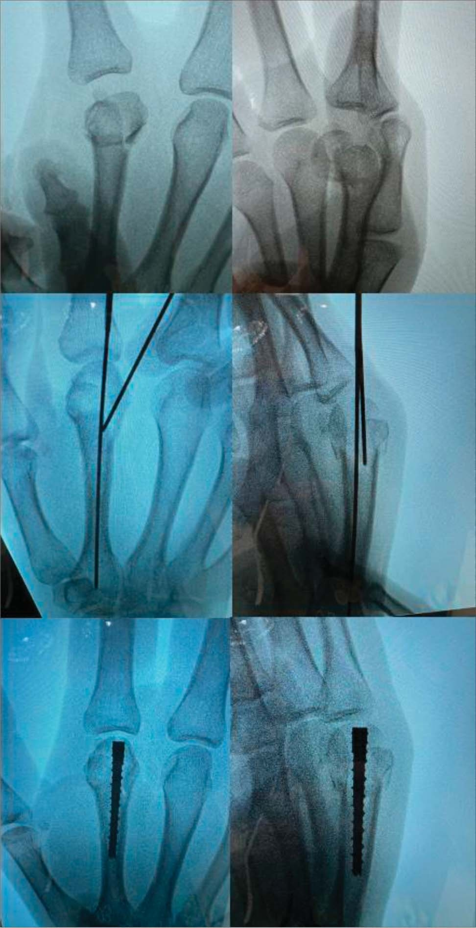 如何精准施策？掌骨骨折的治疗方案全景解读