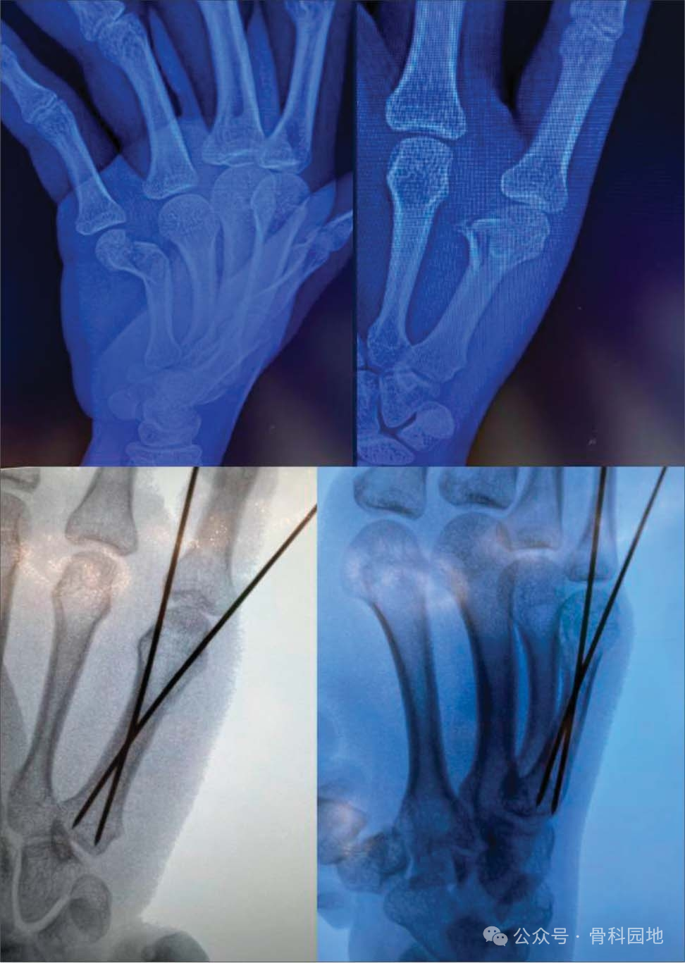 如何精准施策？掌骨骨折的治疗方案全景解读