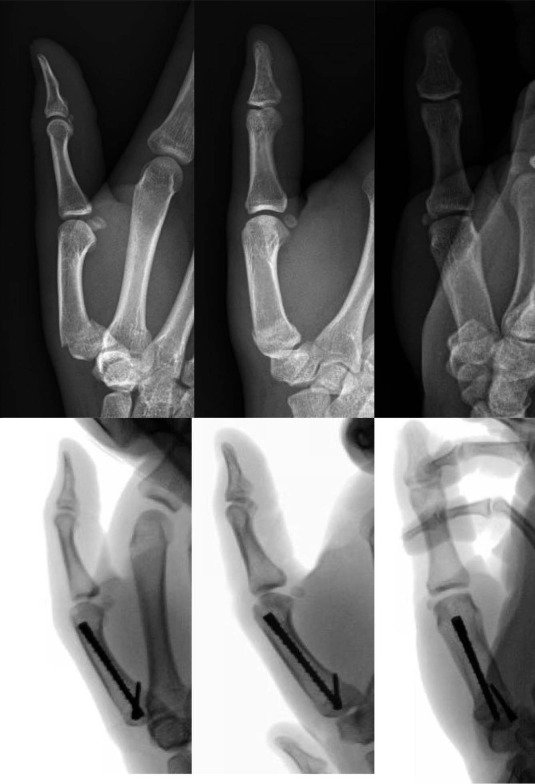 如何精准施策？掌骨骨折的治疗方案全景解读
