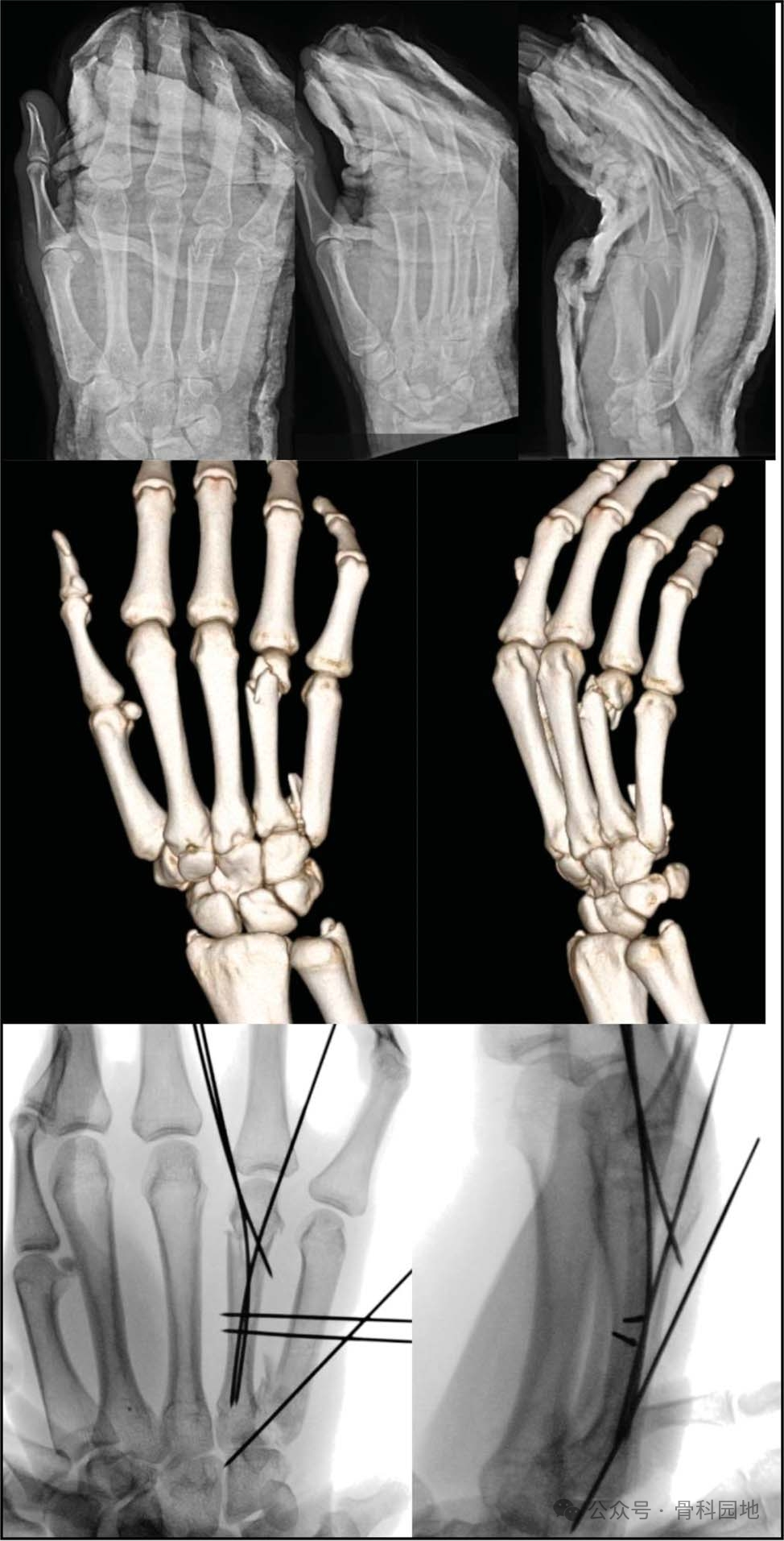 如何精准施策？掌骨骨折的治疗方案全景解读