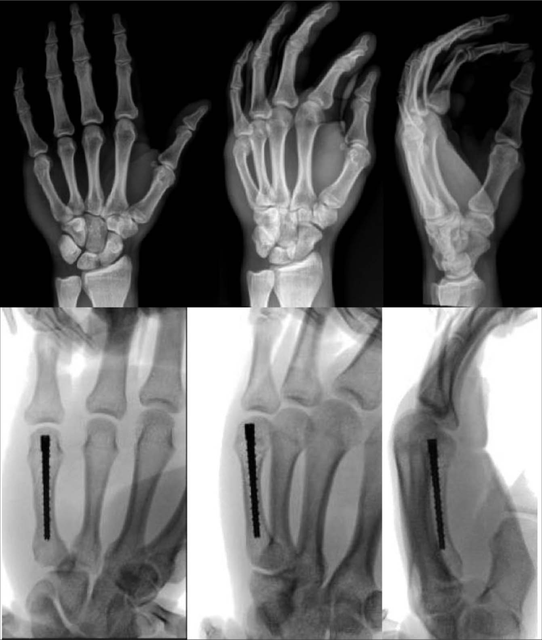 如何精准施策？掌骨骨折的治疗方案全景解读