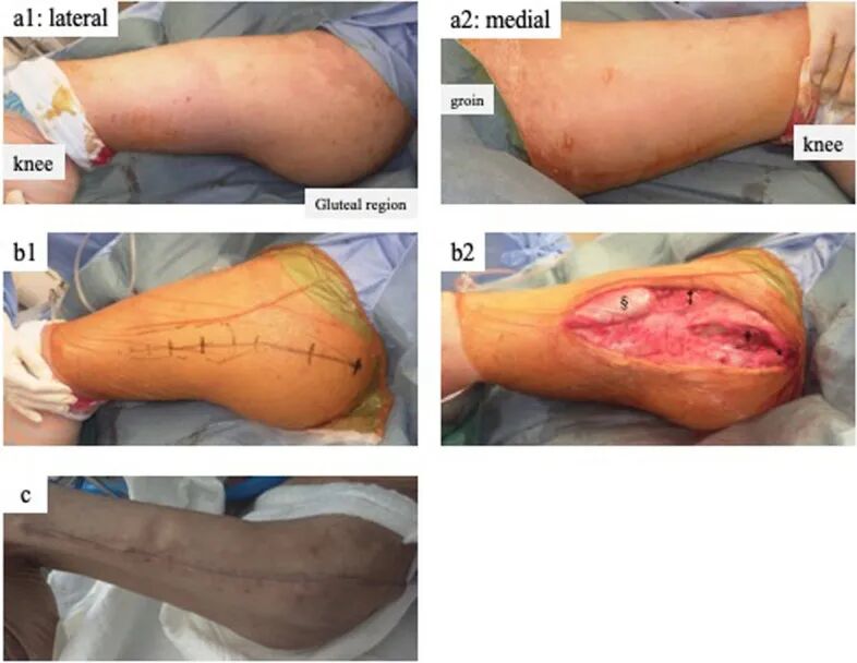 四室告急!因树木砸伤导致多部位骨筋膜室综合征,如何治疗?