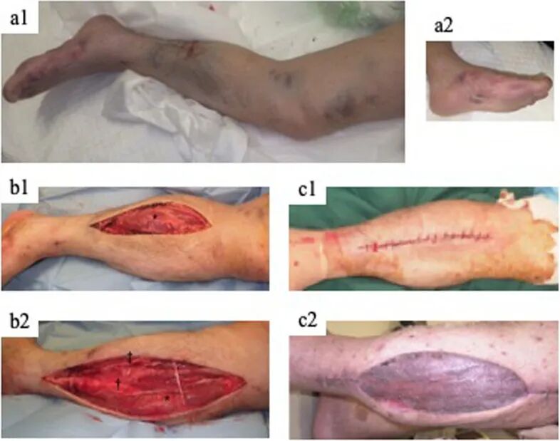 四室告急!因树木砸伤导致多部位骨筋膜室综合征,如何治疗?
