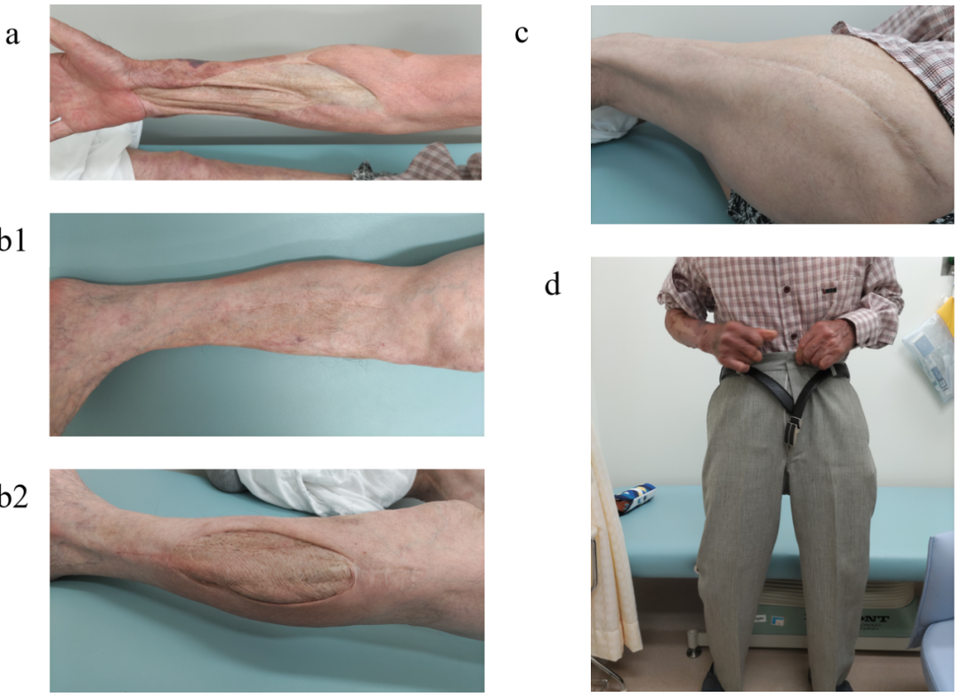 四室告急!因树木砸伤导致多部位骨筋膜室综合征,如何治疗?